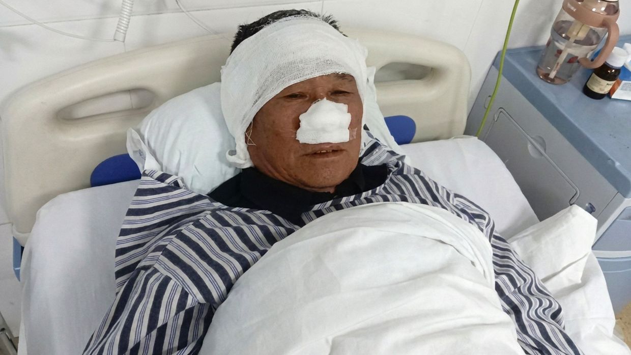 Chinese man loses nose saving woman from attacker, honoured as national hero