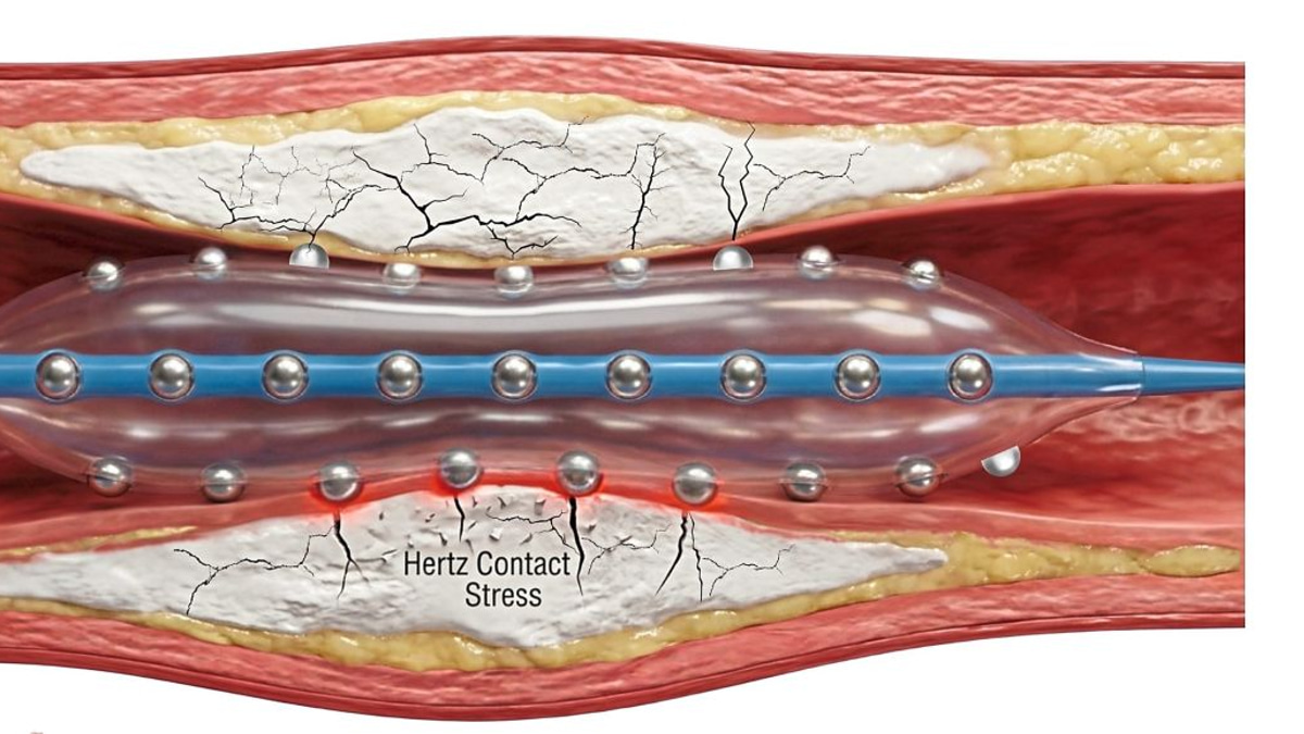 Malaysian cardiologists advance treatment for hardened heart artery blockages with innovative new technology