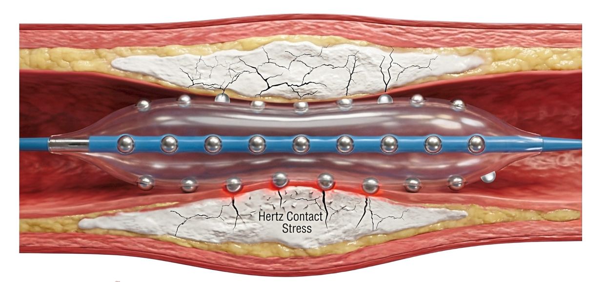 Malaysian cardiologists advance treatment for hardened heart artery blockages with innovative new technology